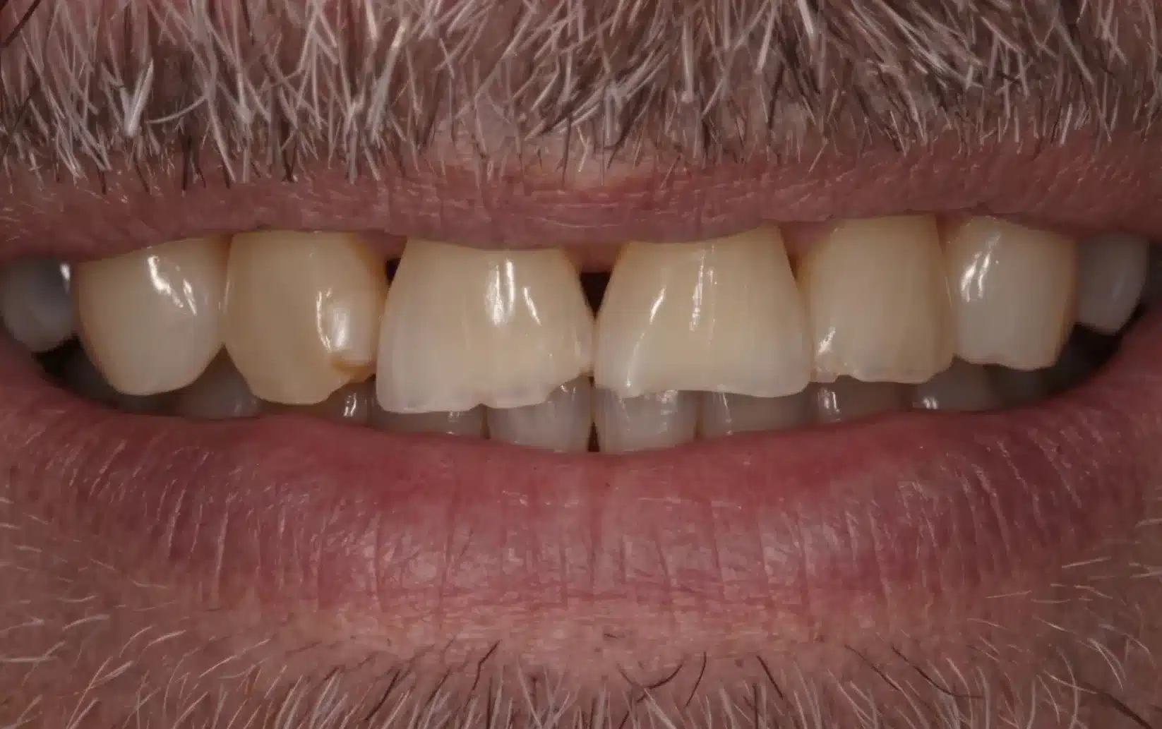 Smile before veneers